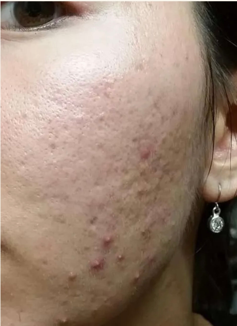 Microneedling with CBD 3 Sessions
